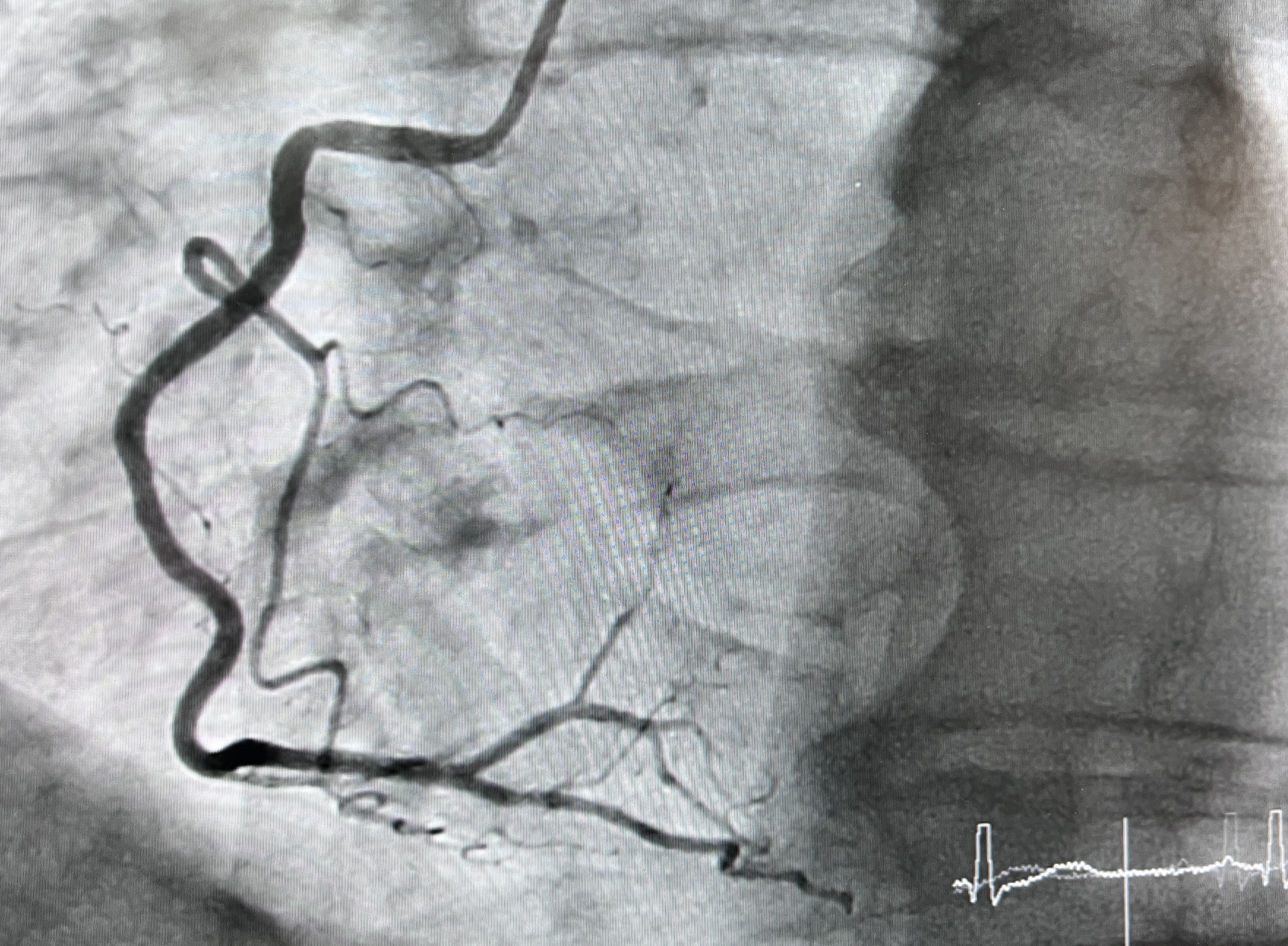 Coronary angiogram showing contrast in heart blood vessels.